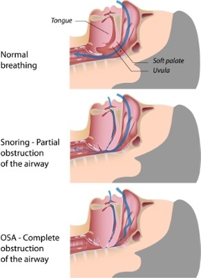 Pozitia limbii si mandibulei in timpul somnului agraveaza dispneea si apneea in somn