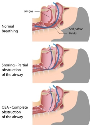sleep apnea and breathing diagram