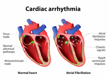 atrial fibrillation can be caused by untreated osa