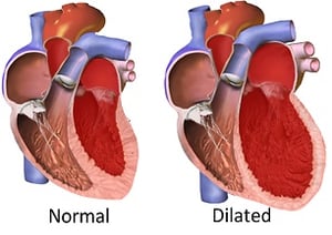 cardiomyopathy happens when the heart enlarges due to stress