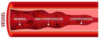 hypertension leads to all kinds of heart problems