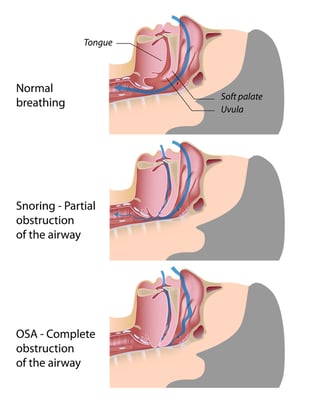 causes of snoring