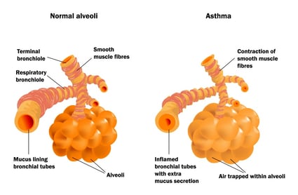 the_alveoli_are_blocked_by_mucus_and_swelling_during_an_asthma_attack