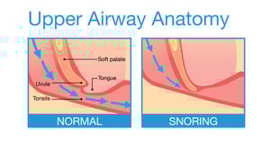 Diagram of upper airway being blocked and causing snoring