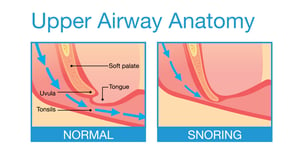 Diagram of upper airway being blocked and causing snoring