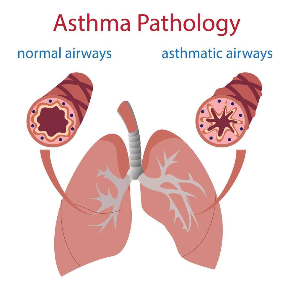 Nocturnal Asthma and Sleep Apnea