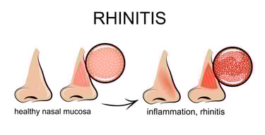 allergic rhinitis is the same thing as hay fever and it can lead to sleep problems if untreated