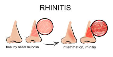 allergic rhinitis is the same thing as hay fever and it can lead to sleep problems if untreated