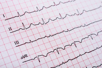 ecg_tracing.jpg