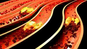clogged_artery.jpg