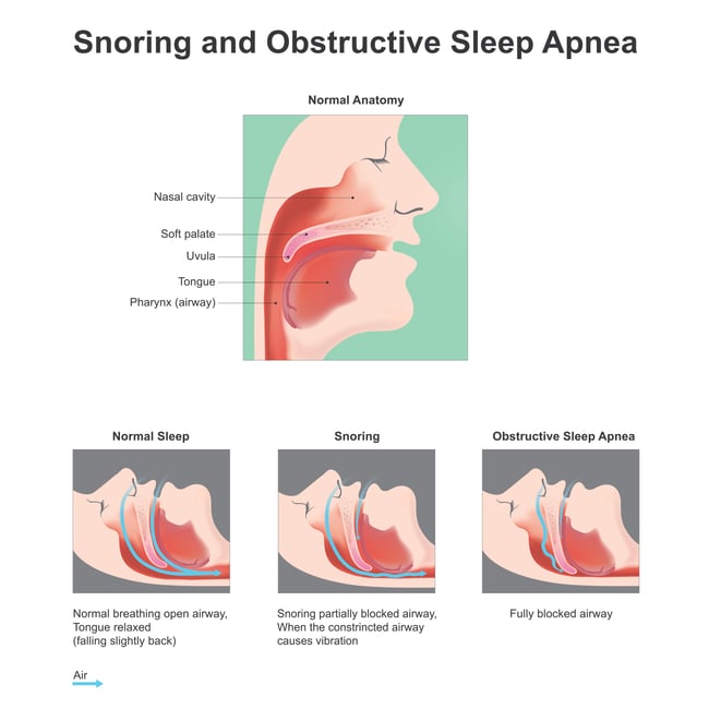 snoring_and_osa_diagram.jpg