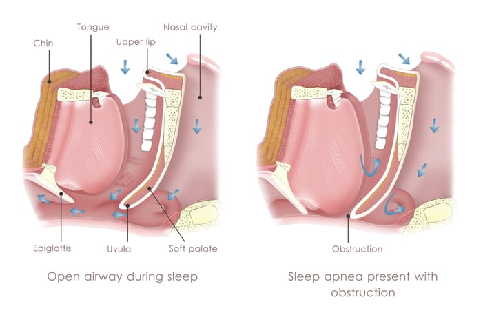 Mixed Apnea Example The different types of sleep apnea: Obstructive, Central and Mixed