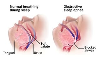obstructive sleep apnea example