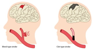 two_kinds_of_stroke.jpg