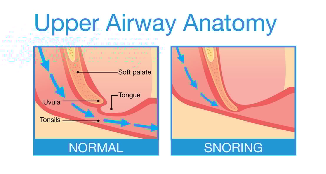 The different types of sleep apnea Obstructive, Central and Mixed